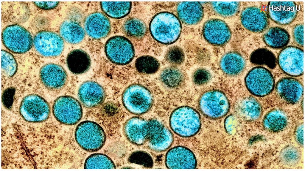 New Cases Of Monkeypox, Measles In Israel